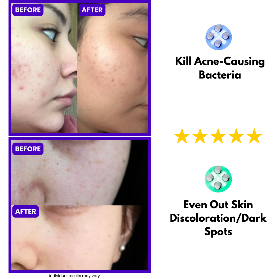 Eclipse® Light Therapy Skincare Wand | With Red and Green Light